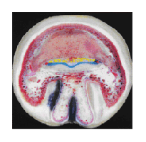 laminitis